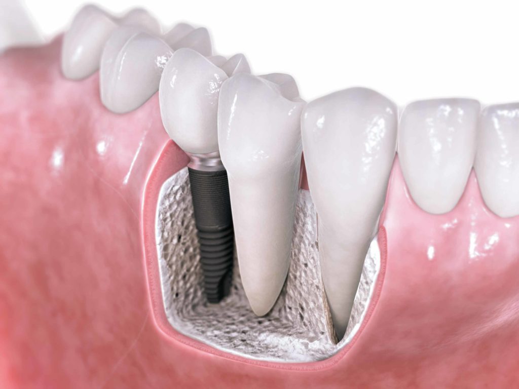 Dental implants in Flower Mound TX